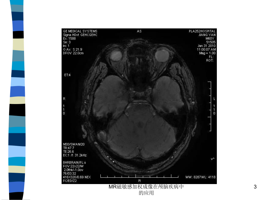 MR磁敏感加权成像在颅脑疾病中的应用课件.ppt_第3页