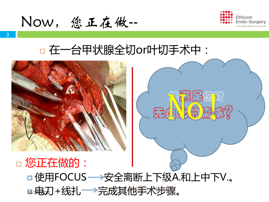 FOCUS在甲状腺手术中的应用课件.ppt_第3页