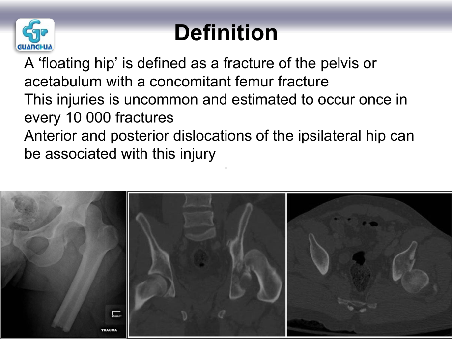 floating-hip-injury-浮髋损伤-课件.ppt_第2页