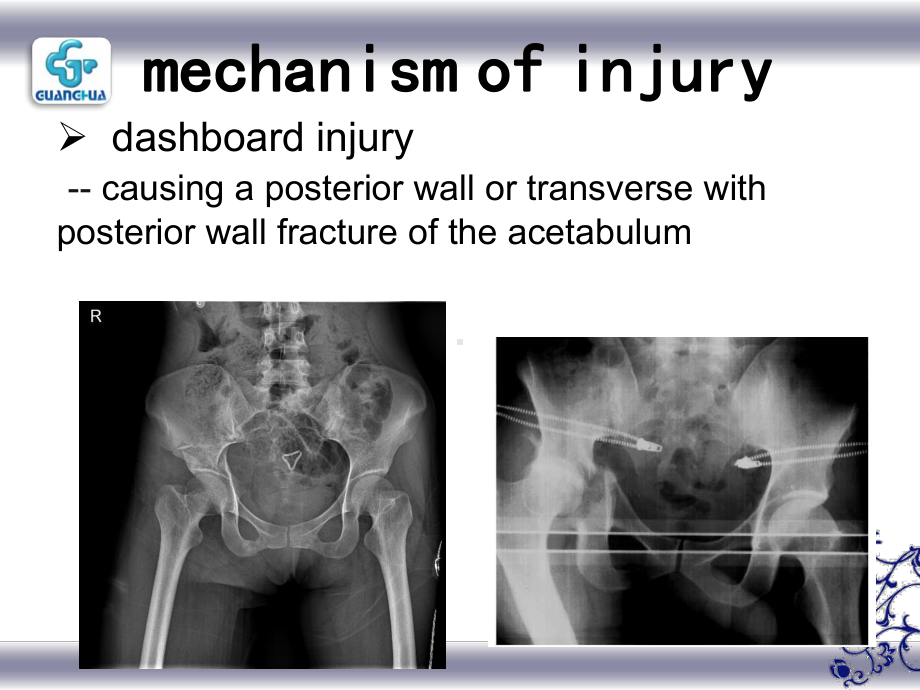 floating-hip-injury-浮髋损伤-课件.ppt_第3页