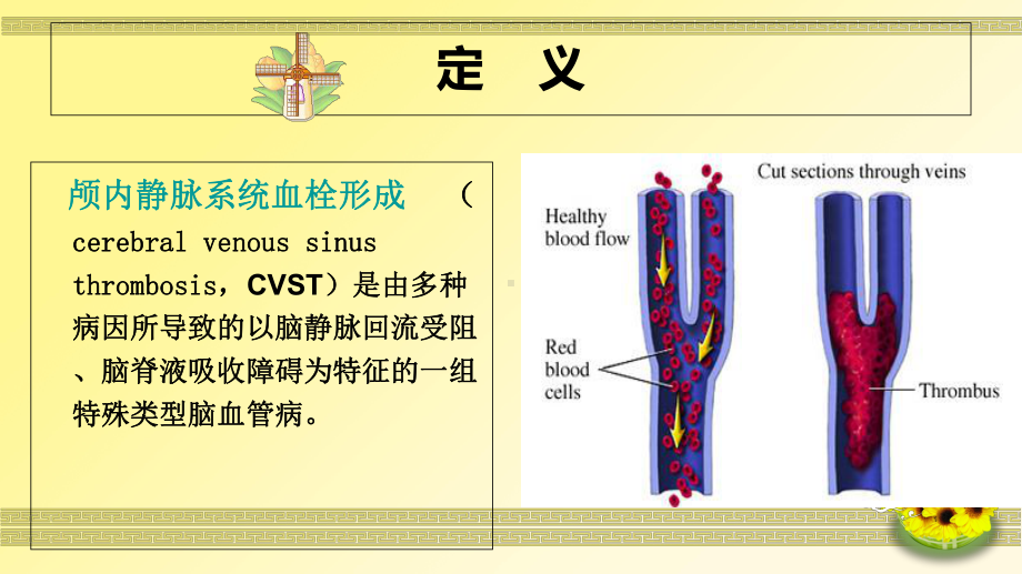 一例颅内静脉窦血栓形成病人的护理-课件.ppt_第2页