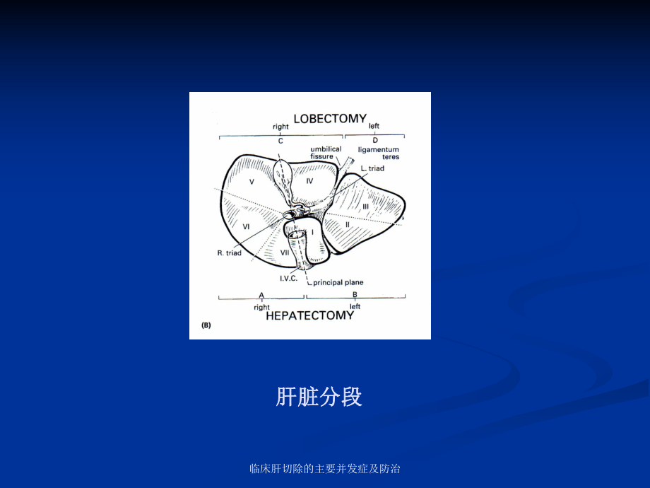 临床肝切除的主要并发症及防治课件.ppt_第3页