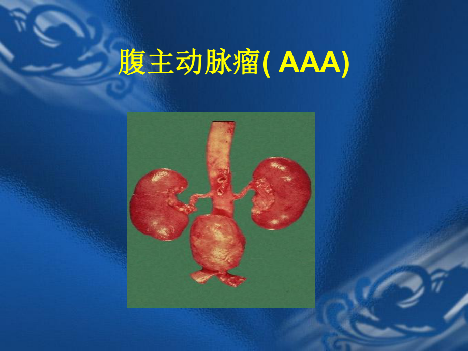 (规培讲课)腹主动脉瘤诊断和治疗课件.ppt_第2页