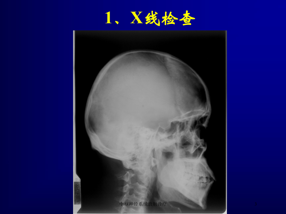 中枢神经系统放射诊疗培训课件.ppt_第3页