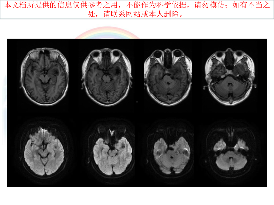 三叉神经鞘瘤-培训课件.ppt_第2页