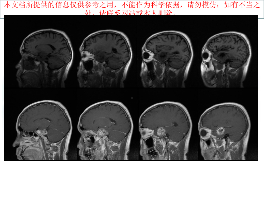 三叉神经鞘瘤-培训课件.ppt_第3页