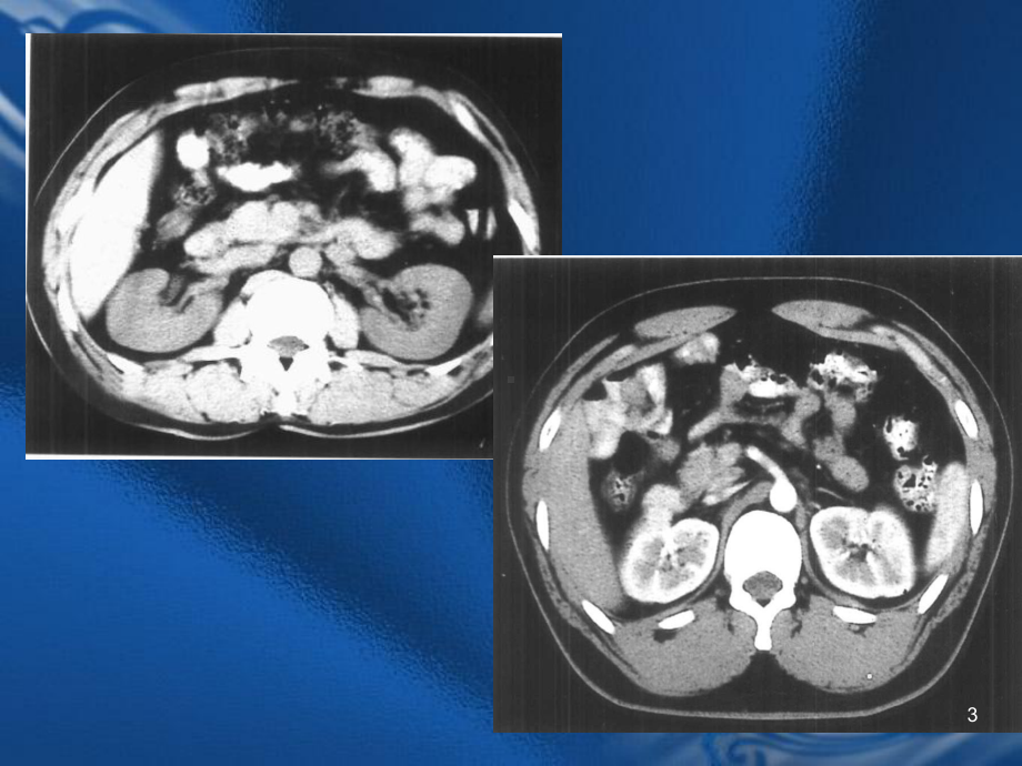 CT诊断学肾脏CT课件.ppt_第3页