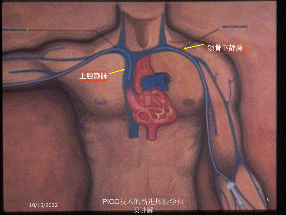 PICC技术的新进展医学知识讲解课件.ppt_第3页