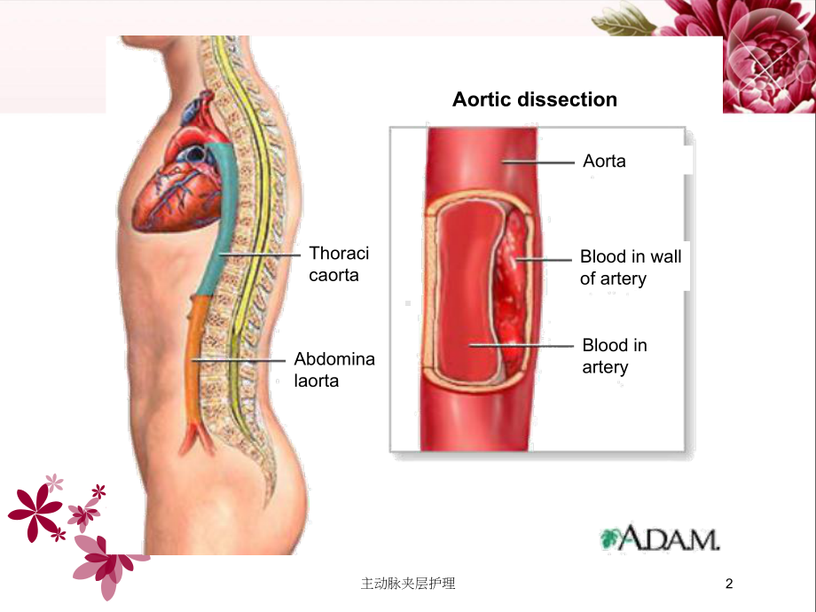 主动脉夹层护理培训课件.ppt_第2页