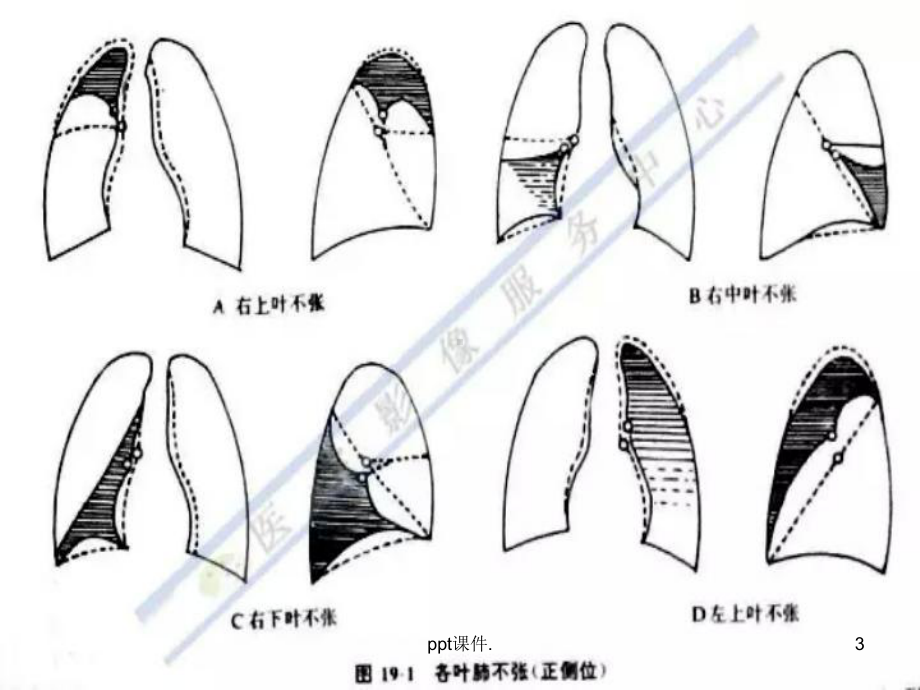 不同部位肺不张的影像特点课件-2.ppt_第3页