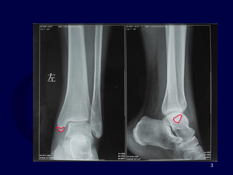 下胫腓联合损伤课件-2.ppt_第3页