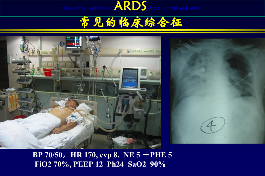 ARDS肺复张的临床实施课件.ppt_第1页