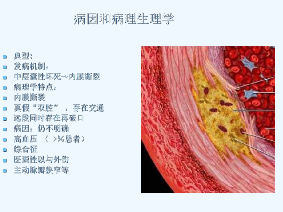 主动脉夹层壁间血肿及穿通性溃疡影像诊断与鉴别诊断课件.ppt_第3页