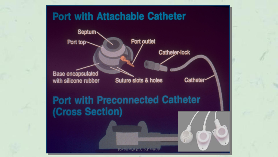 PORT输液港置入手术与护理课件.pptx_第3页