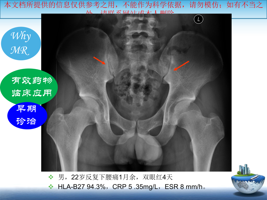 SA骶髂关节炎的影像学诊疗和鉴别诊疗培训课件.ppt_第3页