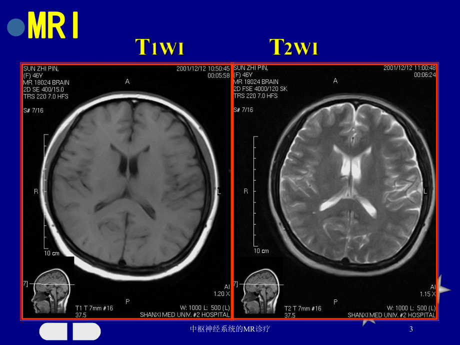 中枢神经系统的MR诊疗培训课件.ppt_第3页