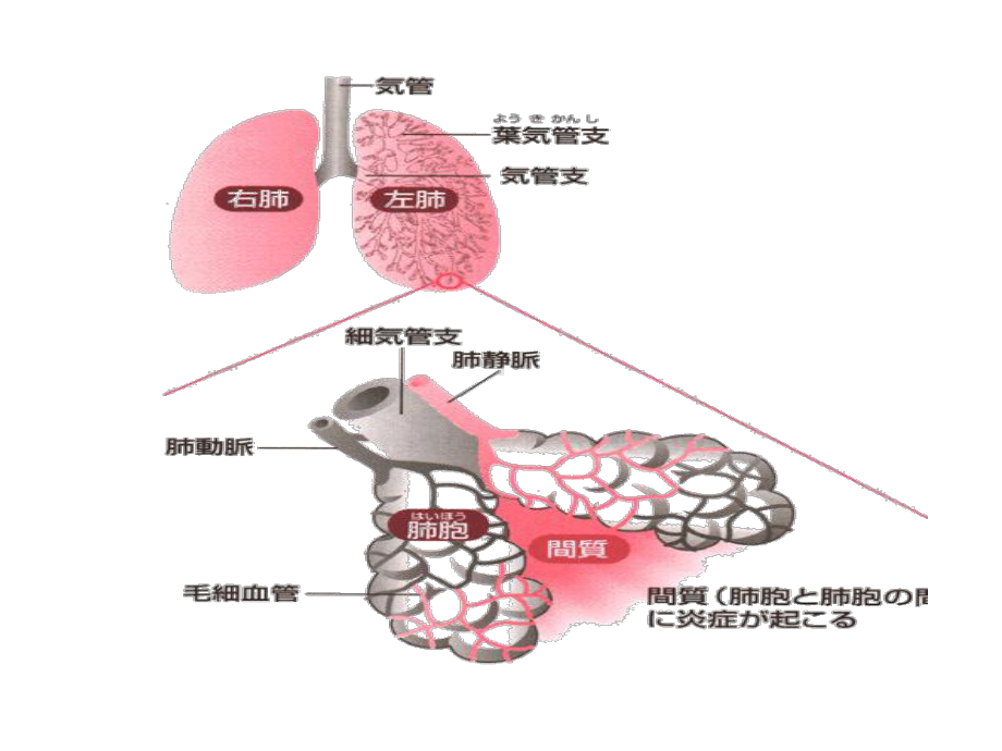 肺炎病人的护理课件.ppt_第3页