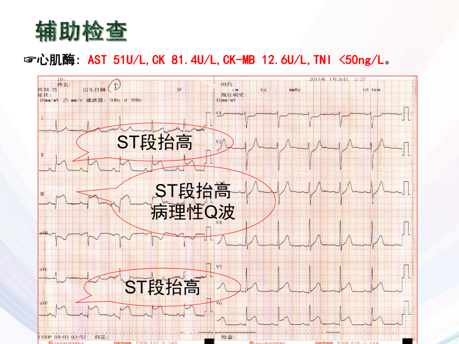 PBL急性心梗课件.ppt_第3页