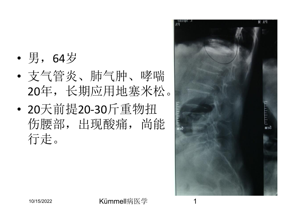 Kümmell病医学培训课件.ppt_第1页