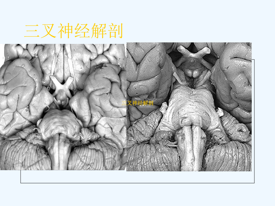 三叉神经痛介入治疗课件.ppt_第3页