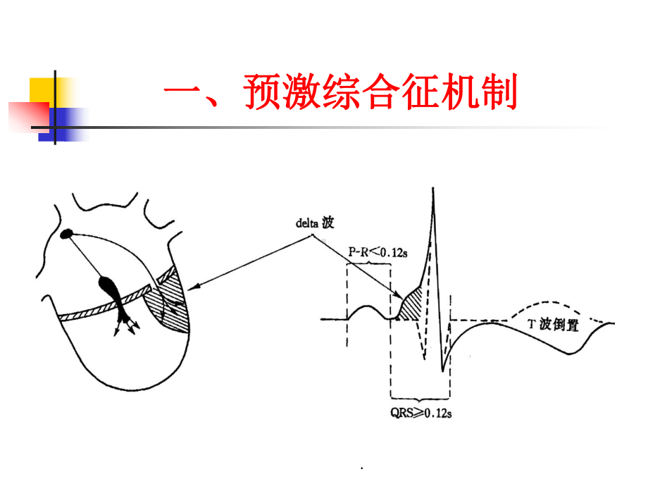 《预激综合征教程》课件.ppt_第2页