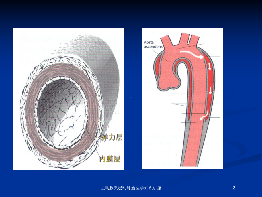 主动脉夹层动脉瘤医学知识讲座培训课件.ppt_第3页