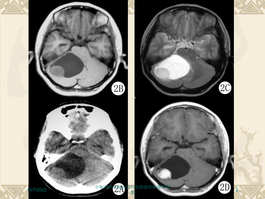 中枢神经系统血管母细胞瘤的影像学图像培训课件.ppt_第2页
