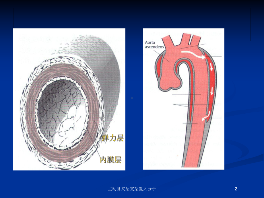 主动脉夹层支架置入分析培训课件.ppt_第2页