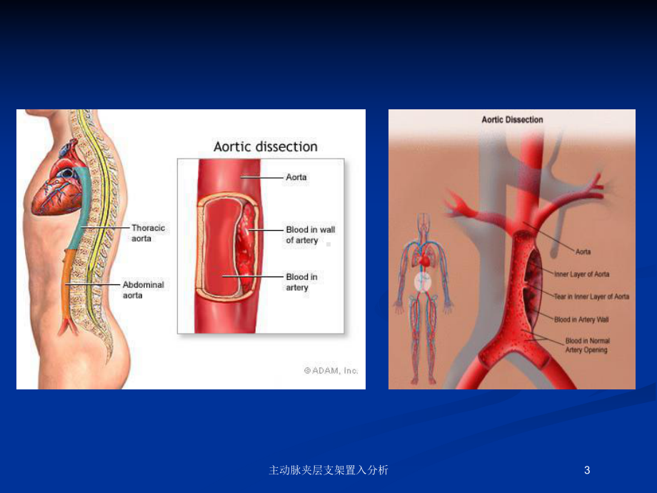 主动脉夹层支架置入分析培训课件.ppt_第3页