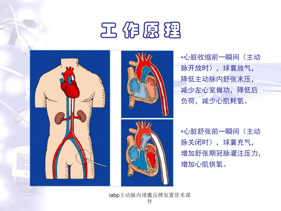 iabp主动脉内球囊反搏泵置管术课件.ppt_第3页