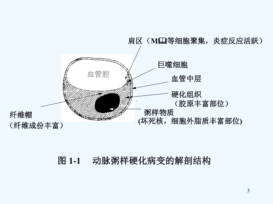 AMI早期诊断及防治课件.ppt_第3页