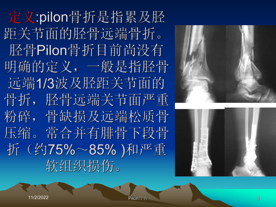 Pilon骨折培训课件.ppt_第1页