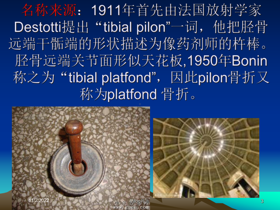 Pilon骨折培训课件.ppt_第3页