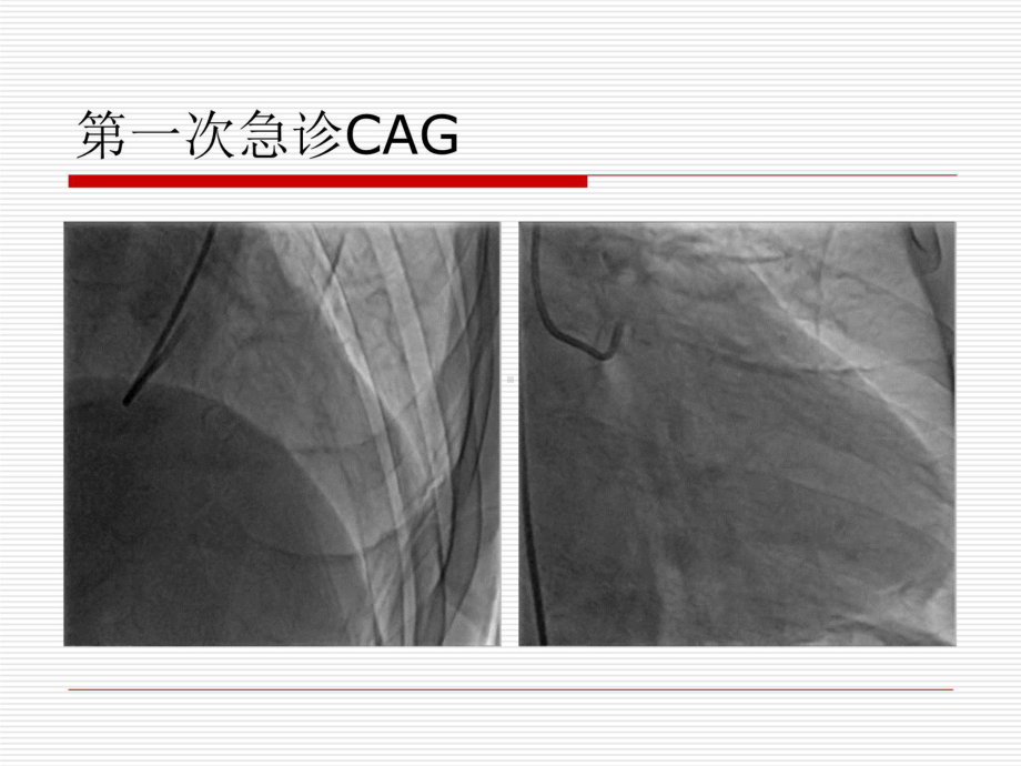 pci术中的冠状动脉痉挛病例-胡奉环课件.ppt_第3页