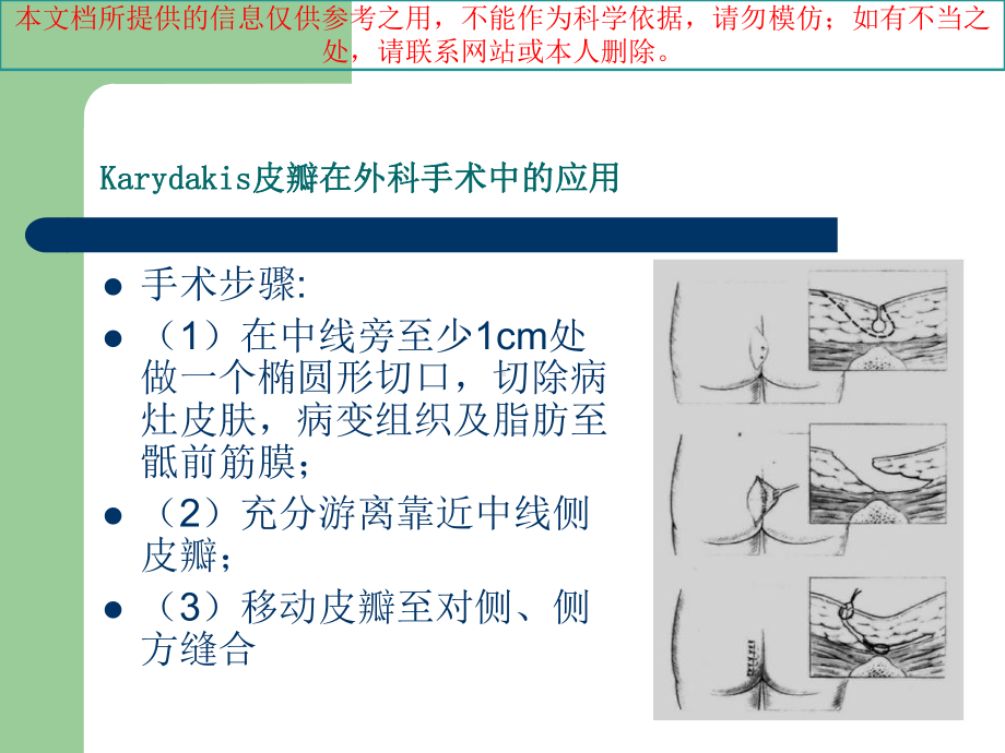 Karydakis皮瓣在外科手术中的应用培训课件.ppt_第3页