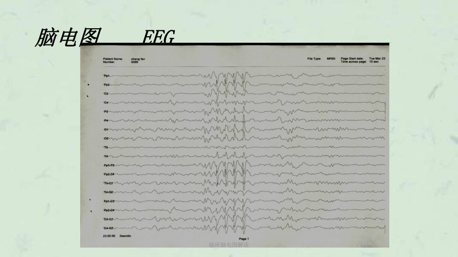 临床脑电图解读课件.ppt_第3页