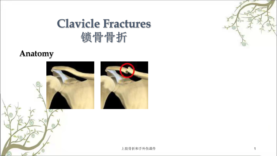 上肢骨折和手外伤课件.ppt_第1页
