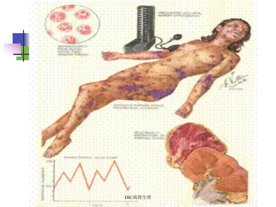 DIC病理生理培训课件.ppt_第2页