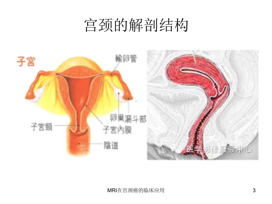 MRI在宫颈癌的临床应用课件.ppt_第3页