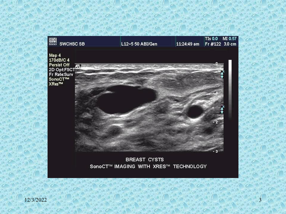 《乳腺囊肿》课件.ppt_第3页