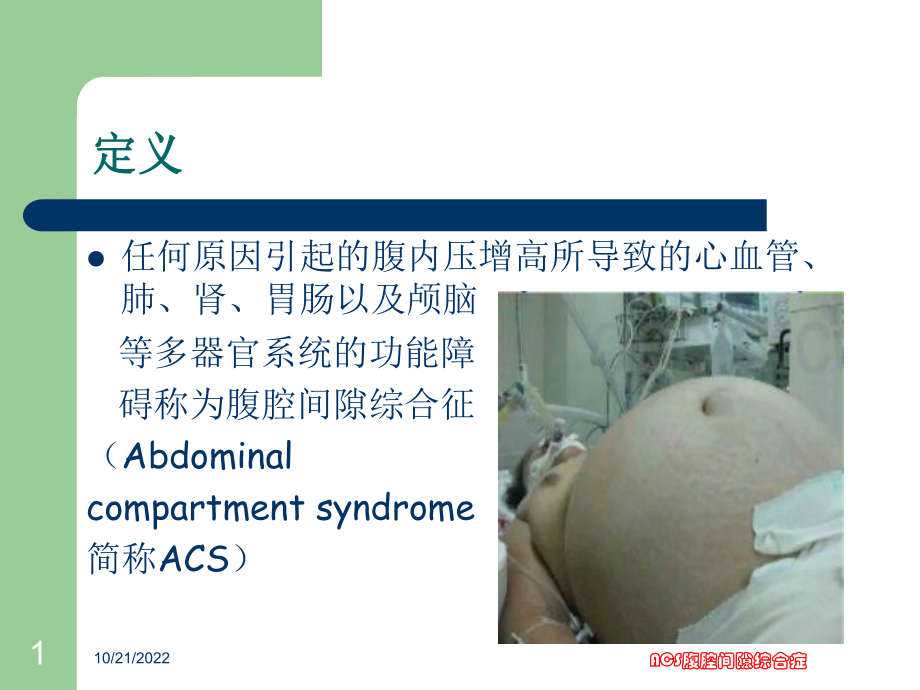 ACS腹腔间隙综合症培训课件.ppt_第1页