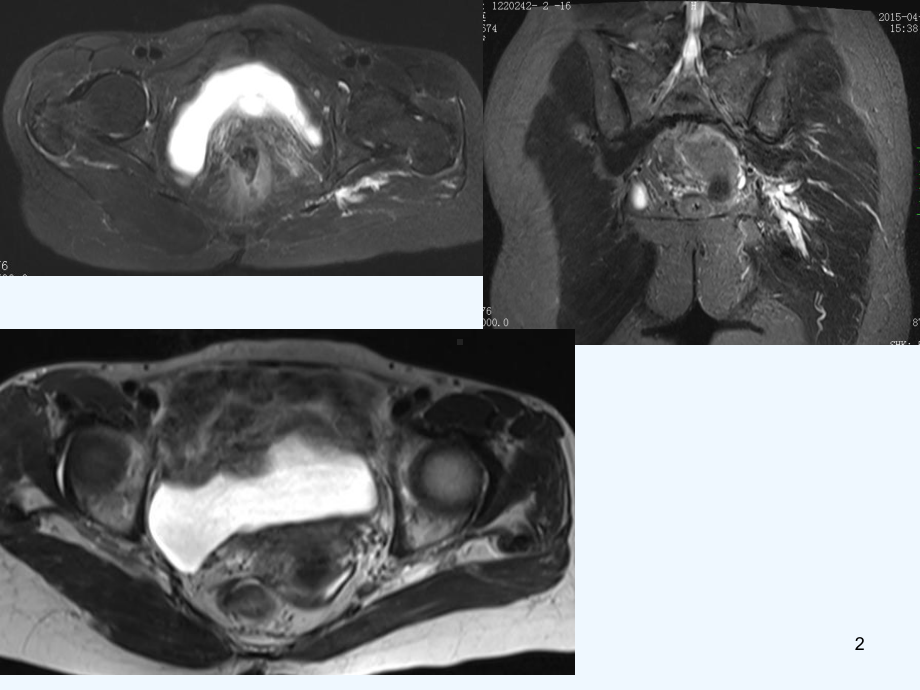MR在梨状肌综合征诊断中应用课件.ppt_第2页