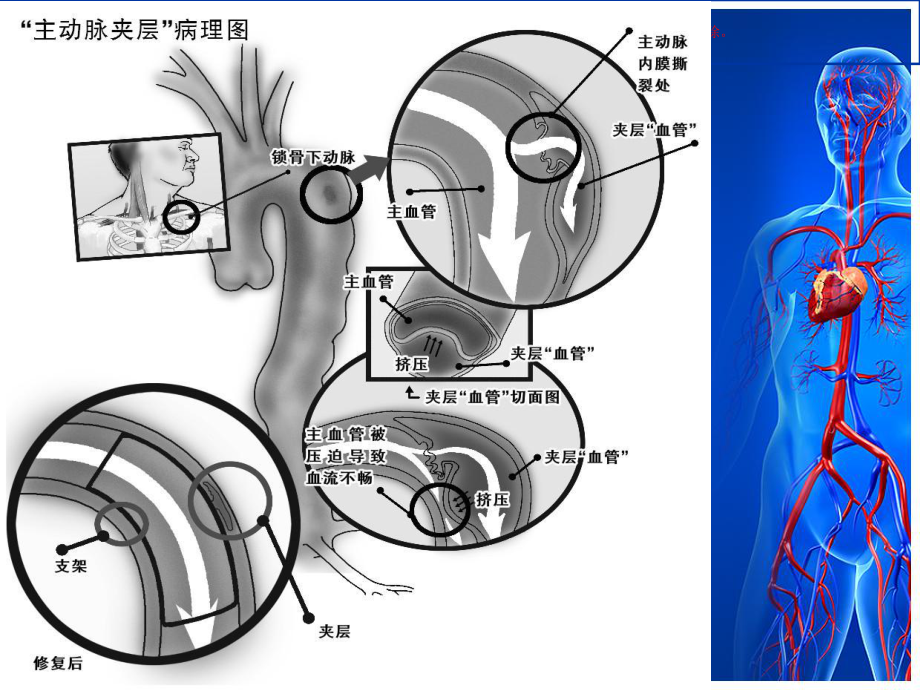 主动脉夹层护理查房培训课件.ppt_第2页