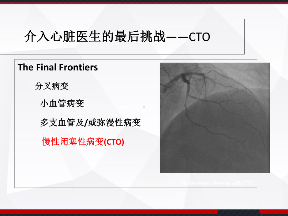 CTO介入治疗处理流程-课件.ppt_第2页