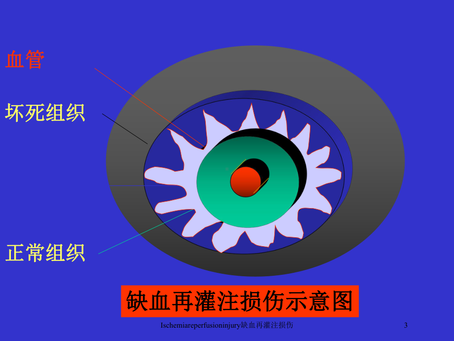 Ischemiareperfusioninjury缺血再灌注损伤培训课件.ppt_第3页