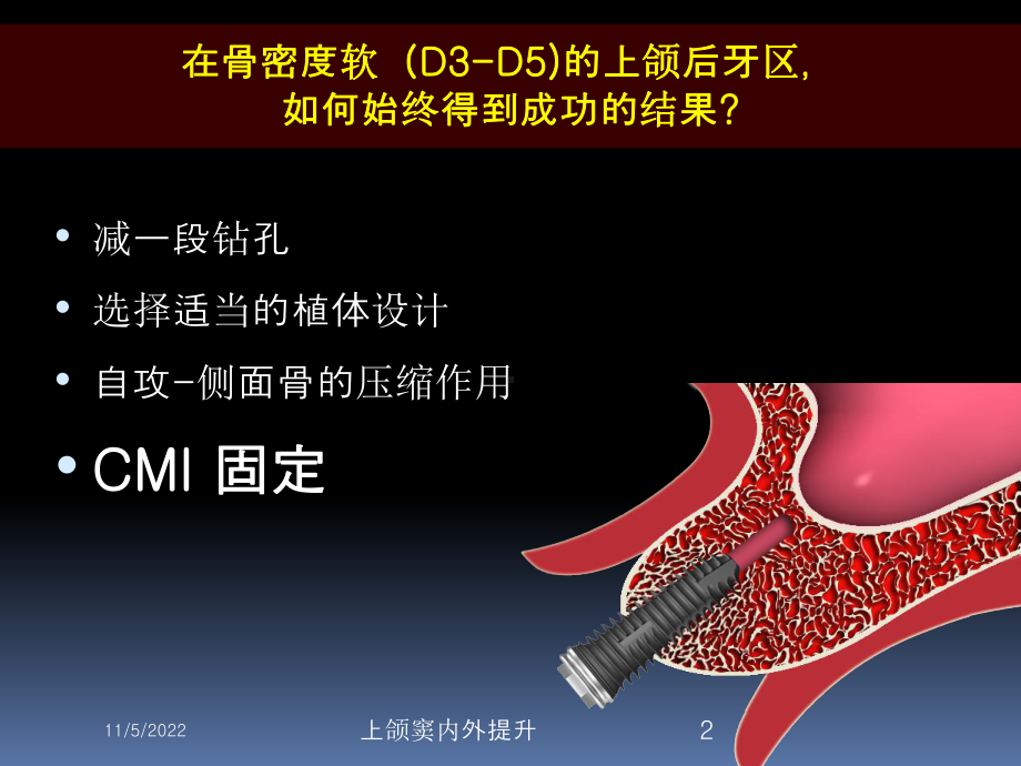 上颌窦内外提升培训课件.ppt_第2页