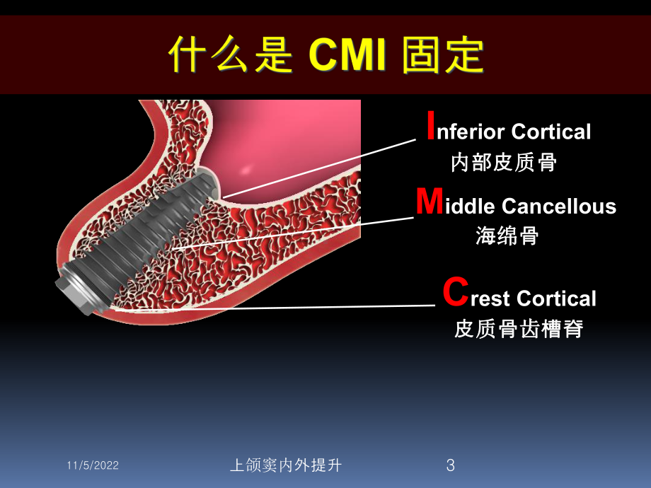 上颌窦内外提升培训课件.ppt_第3页