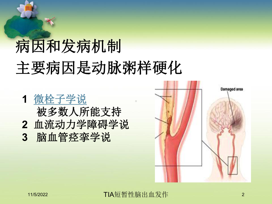 TIA短暂性脑出血发作培训课件.ppt_第2页