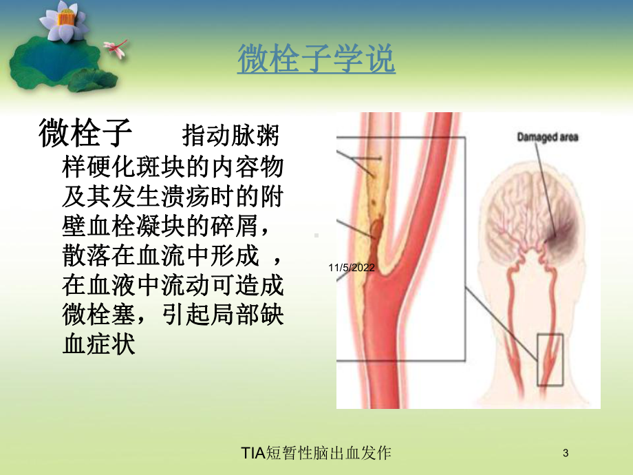 TIA短暂性脑出血发作培训课件.ppt_第3页