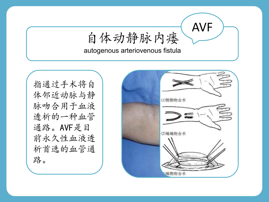 一例使用AVF血液透析患者的护理查房课件.pptx_第3页